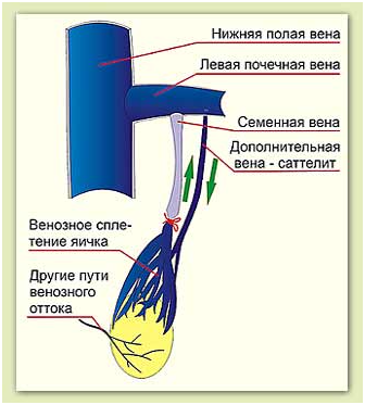Расширение вены семенного канатика. Семенные вены анатомия. Внутренняя семенная Вена. Варикоцеле анатомия вены.