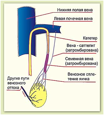 Расширение семенной вены. Эмболизация семенной вены. Эмболизация яичковой вены. Эмболизация внутренней семенной вены.